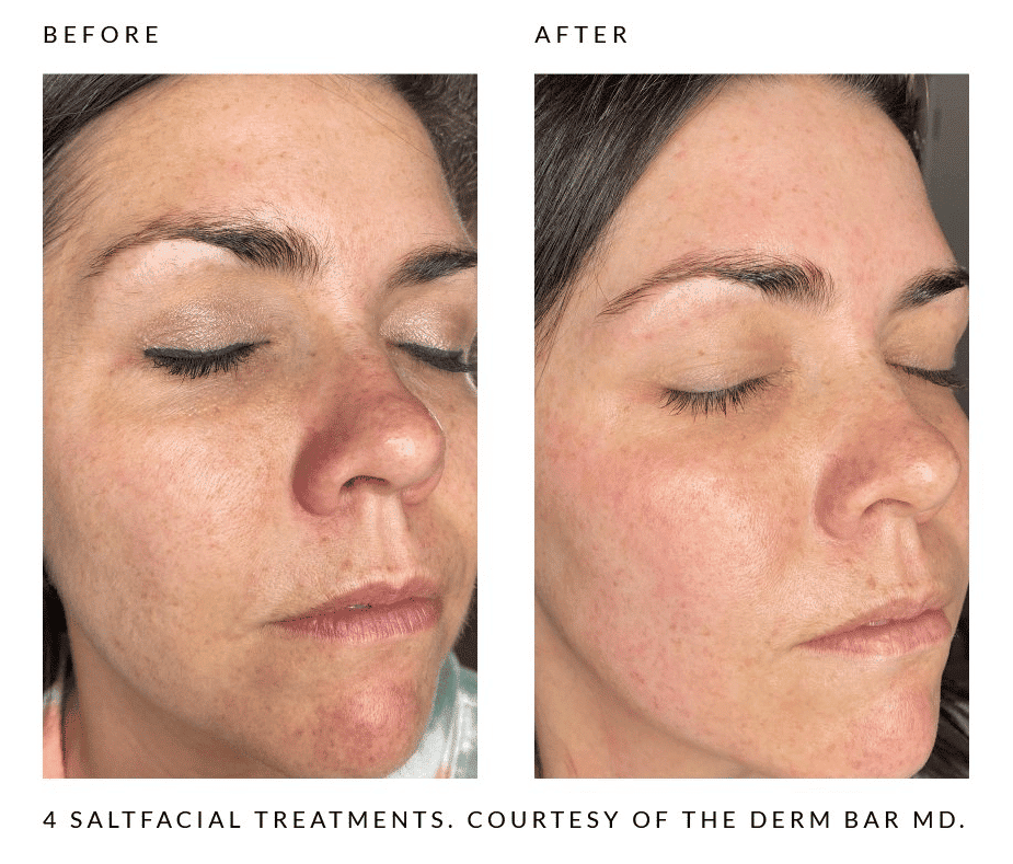 Woman's before and after results from salt facial treatment at Revenge MD.