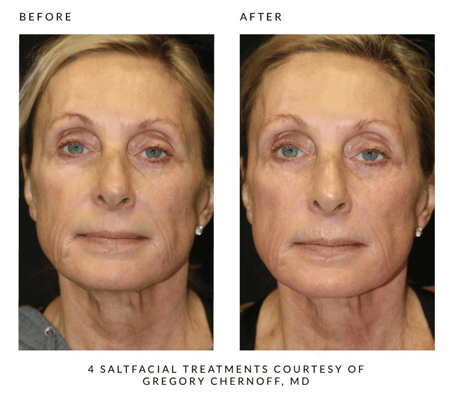 Woman's before and after results from salt facial treatment at Revenge MD.