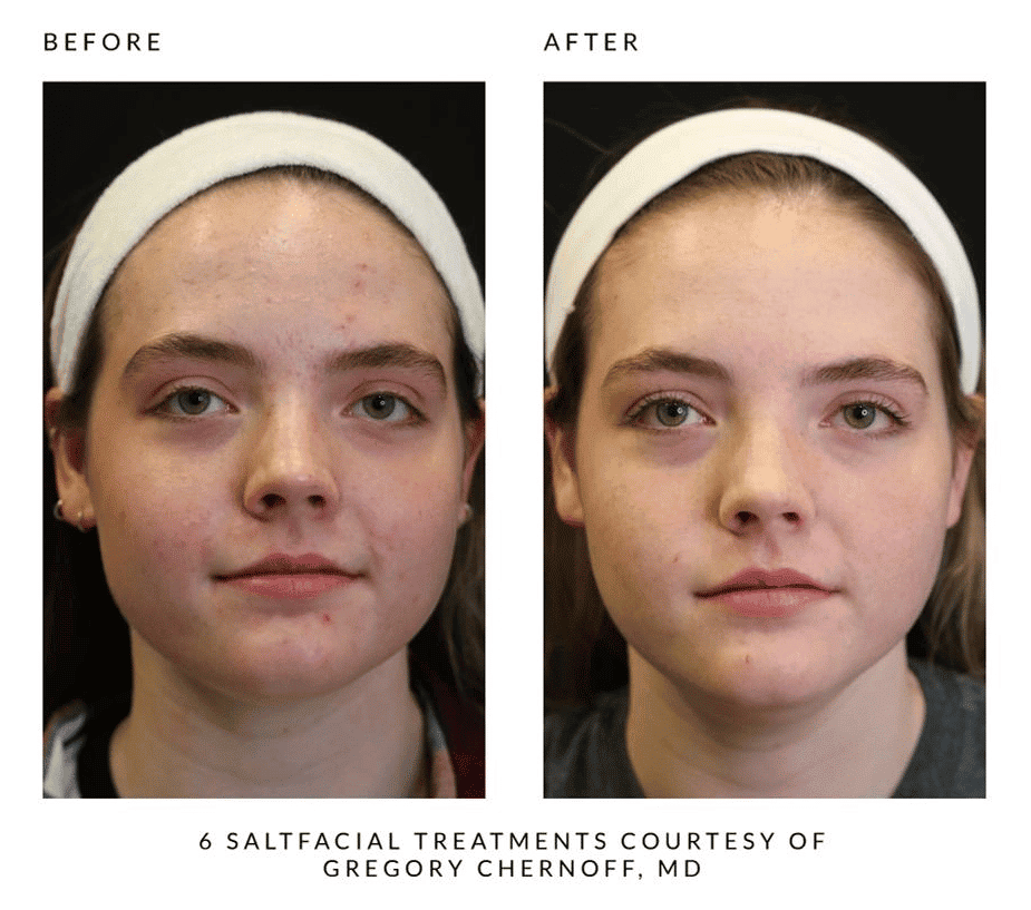 Woman's before and after results from salt facial treatment at Revenge MD.