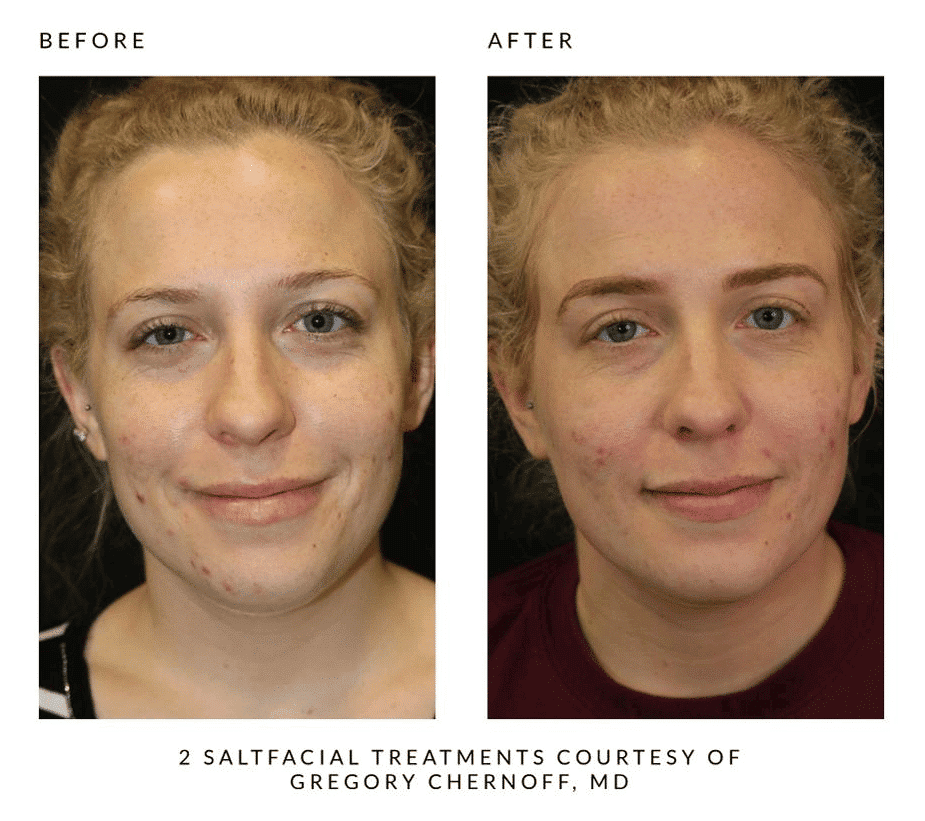 Woman's before and after results from salt facial treatment at Revenge MD.