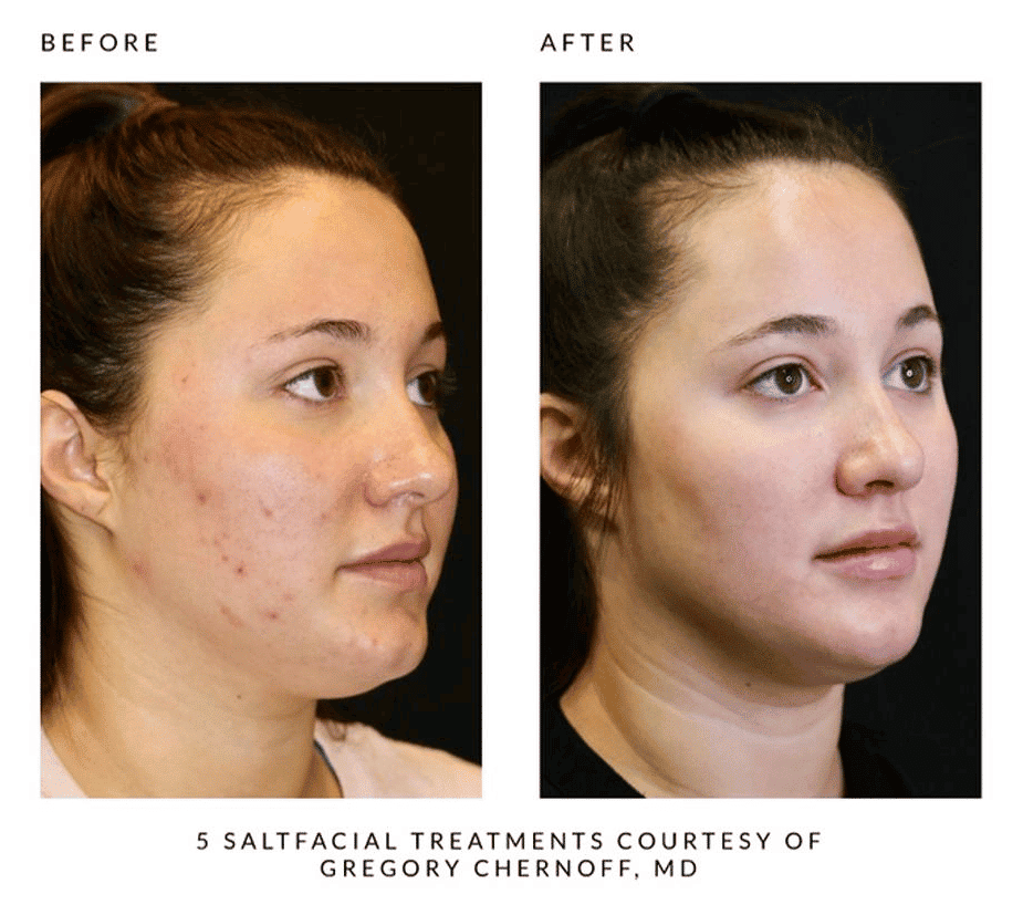 Woman's before and after results from salt facial treatment at Revenge MD.