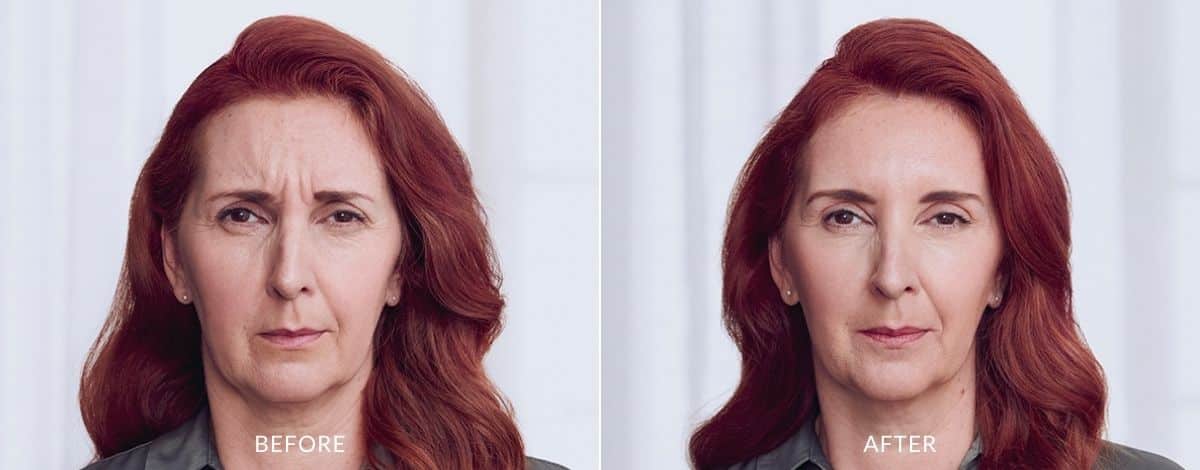 Botox Before and After | Revenge MD