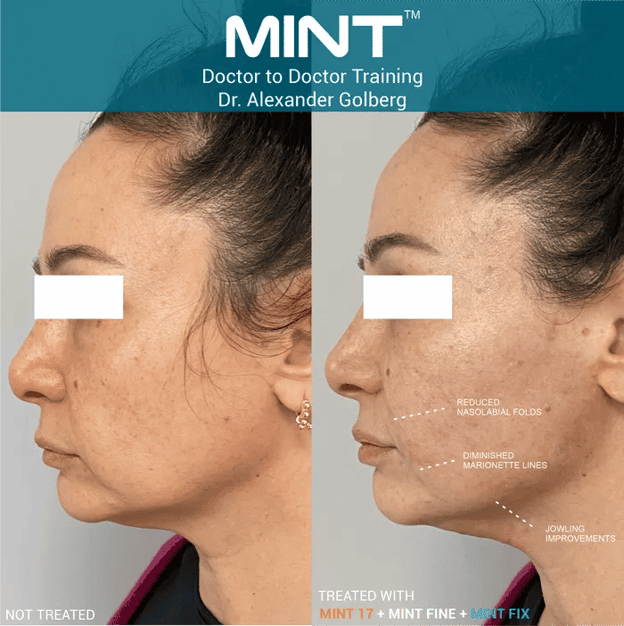 Woman's side profile lifted with pdo threads.