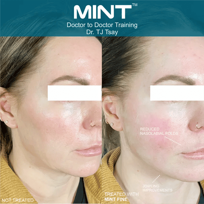 Woman's side profile lifted with pdo threads.