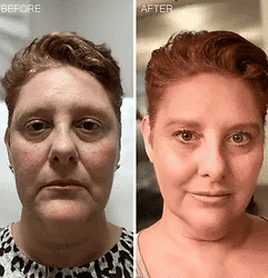 Woman looks like ages reversed with PDO threads.