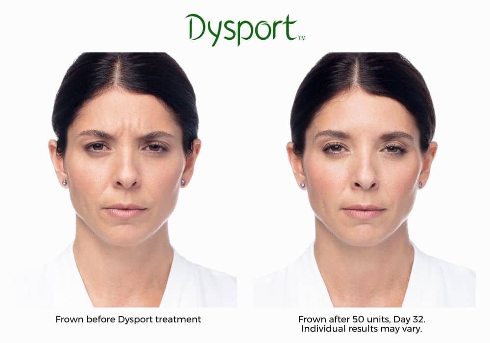 Dysport Treatment Before & After Results