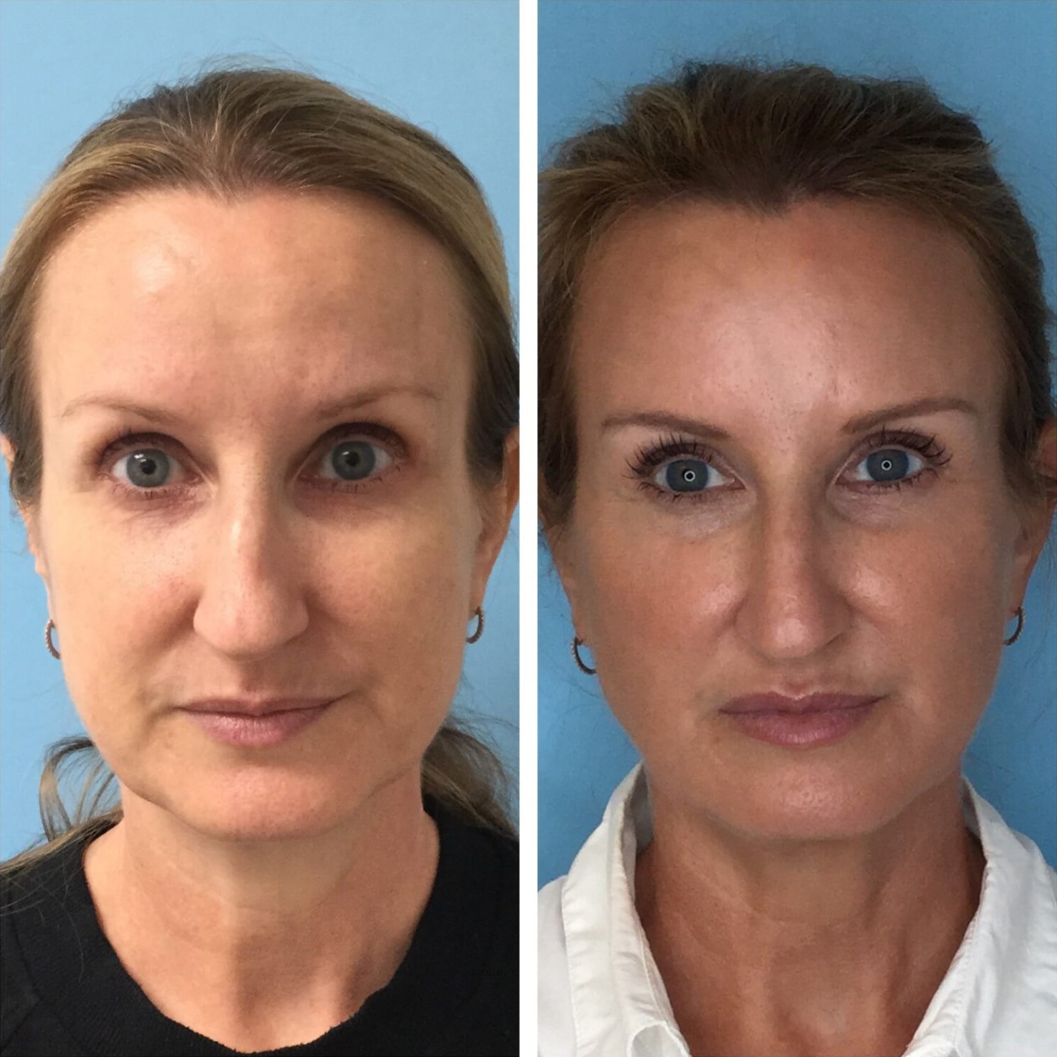 Woman's full face profile lifted with pdo threads.