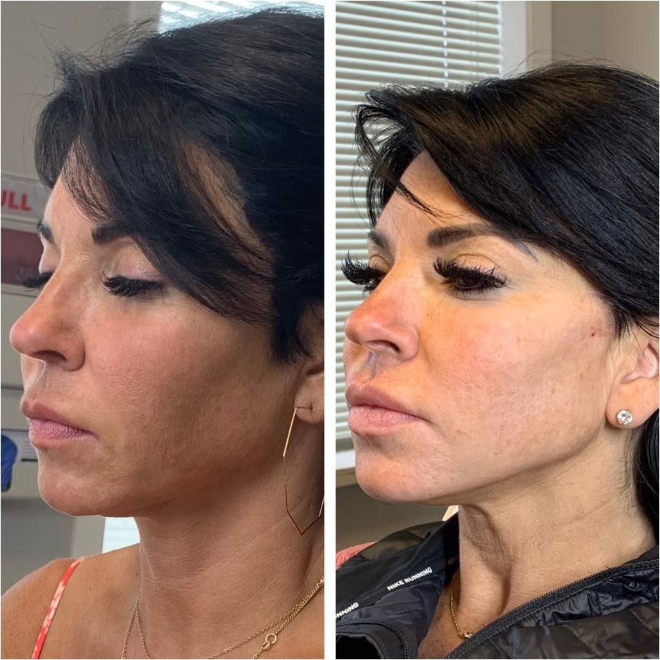 Woman's side profile lifted with pdo threads.