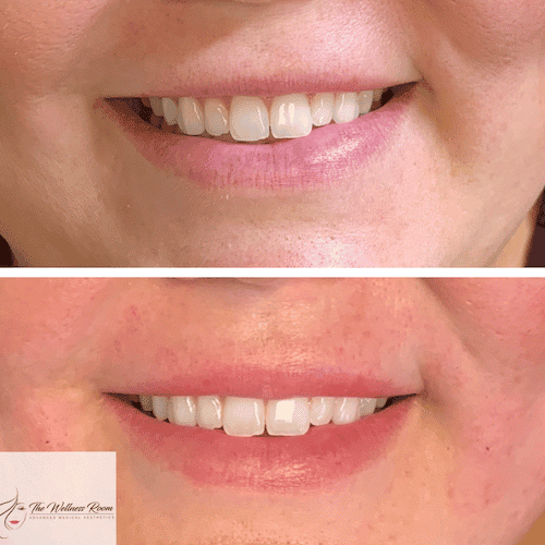 Woman's mouth area lifted with pdo threads.