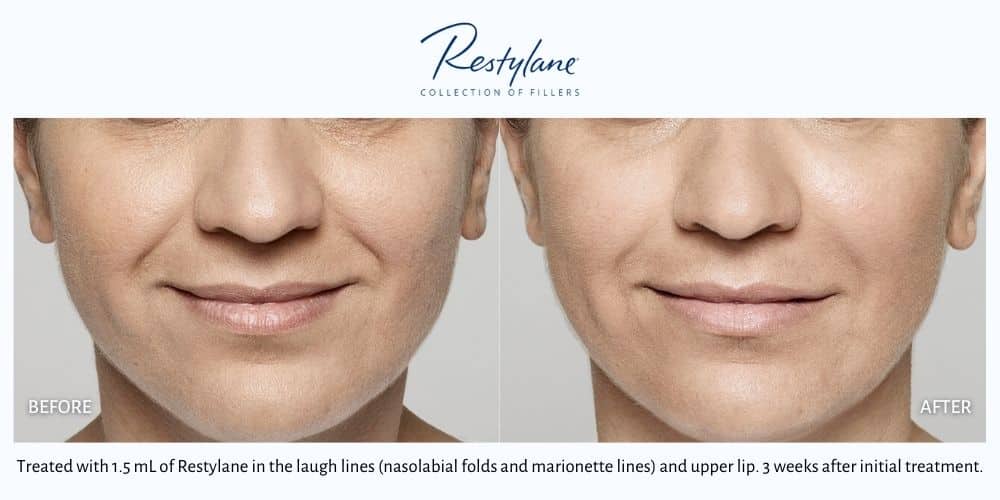 Woman's mouth showing deep lines before and smoother, more plump skin after Restylane treatment at Revenge MD in Las Vegas and Reno.