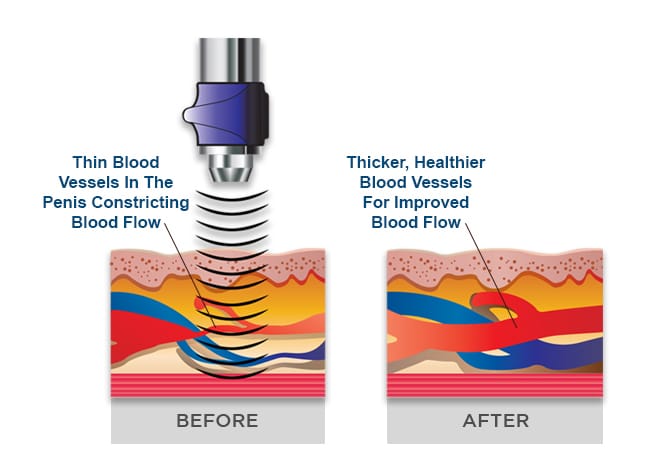 GAINSWave-Treatment in Nevada