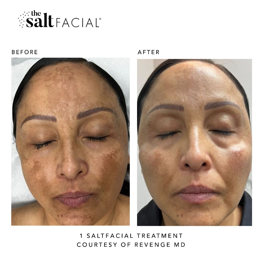 Woman's before and after results from salt facial treatment at Revenge MD.