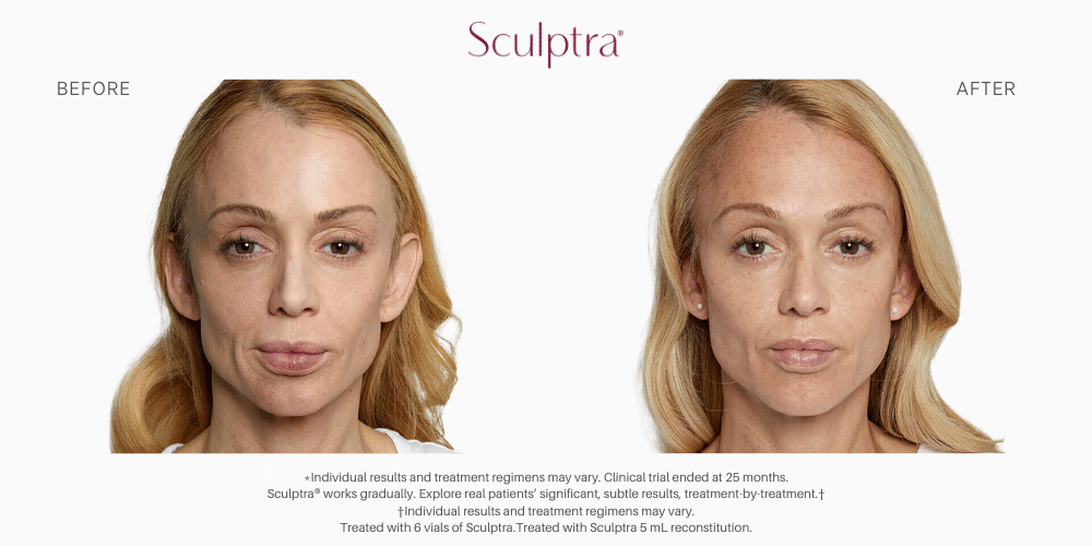 Sculptra Before and after image in Nevada