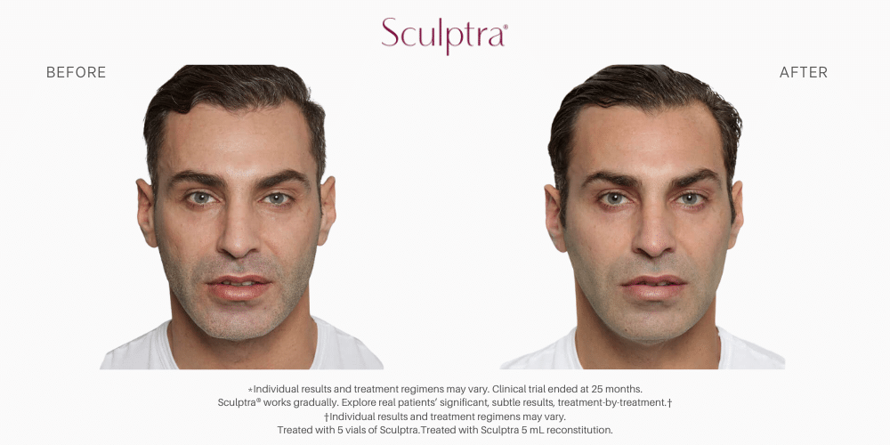 Sculptra Before and after image in Nevada