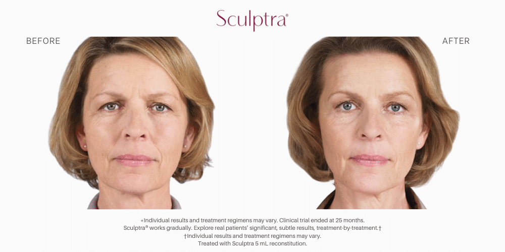 Sculptra Before and after image in Nevada