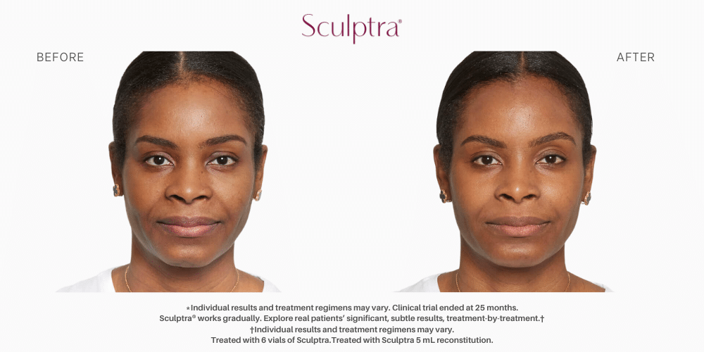Sculptra Before and after image in Nevada