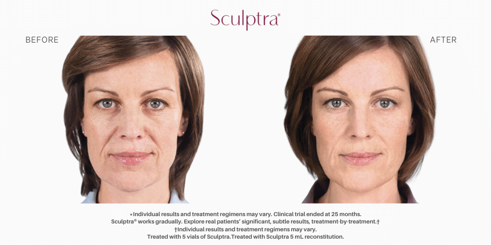 Sculptra Before and after image in Nevada