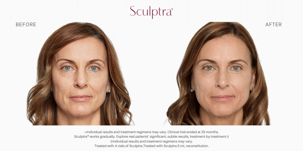 Sculptra Before and after image in Nevada