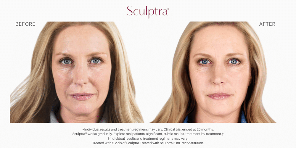 Sculptra Before and after image in Nevada