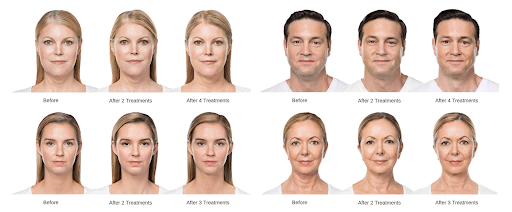 Kybella before and after photos