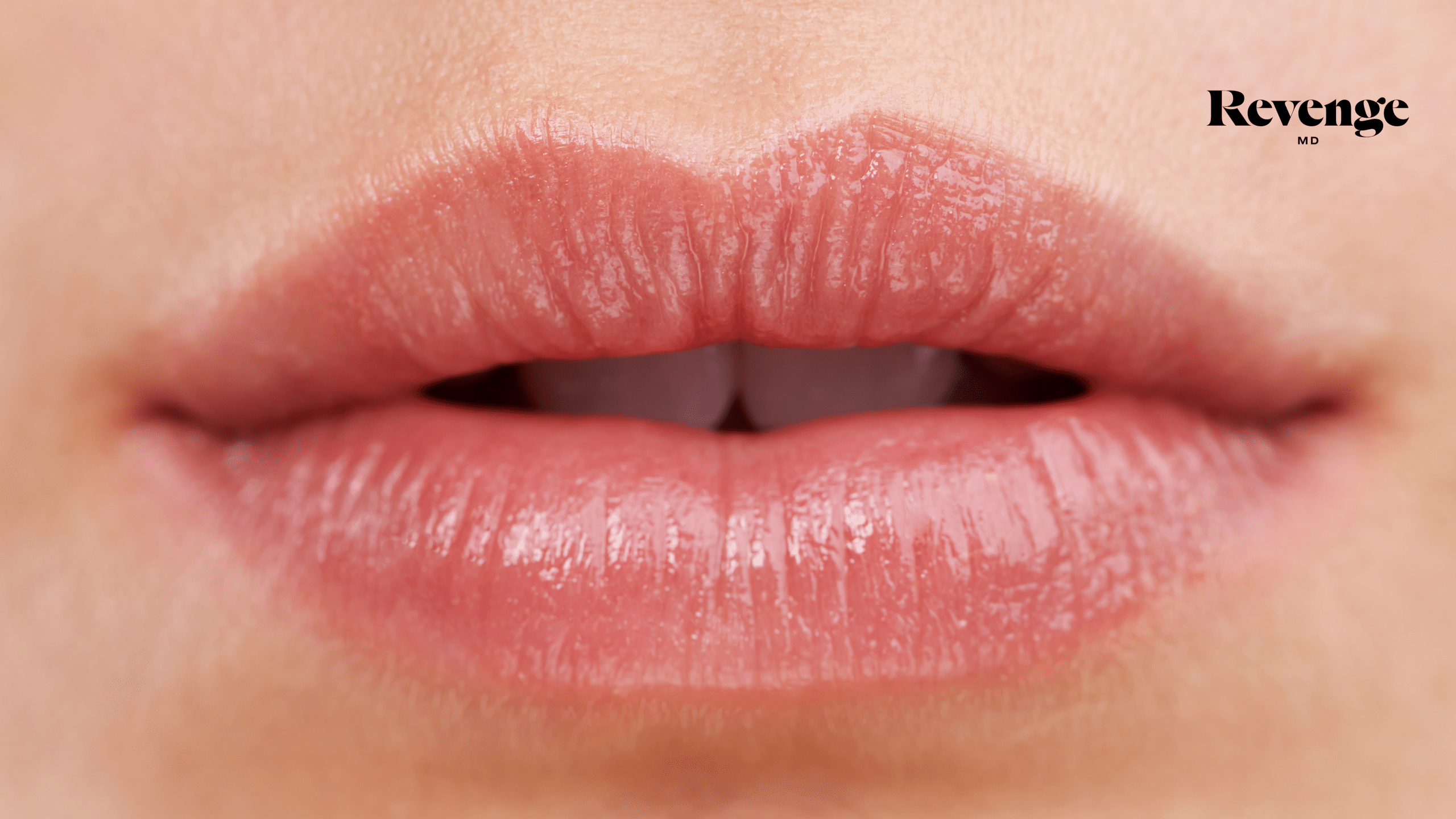 Top FAQs About Lip Fillers Answered