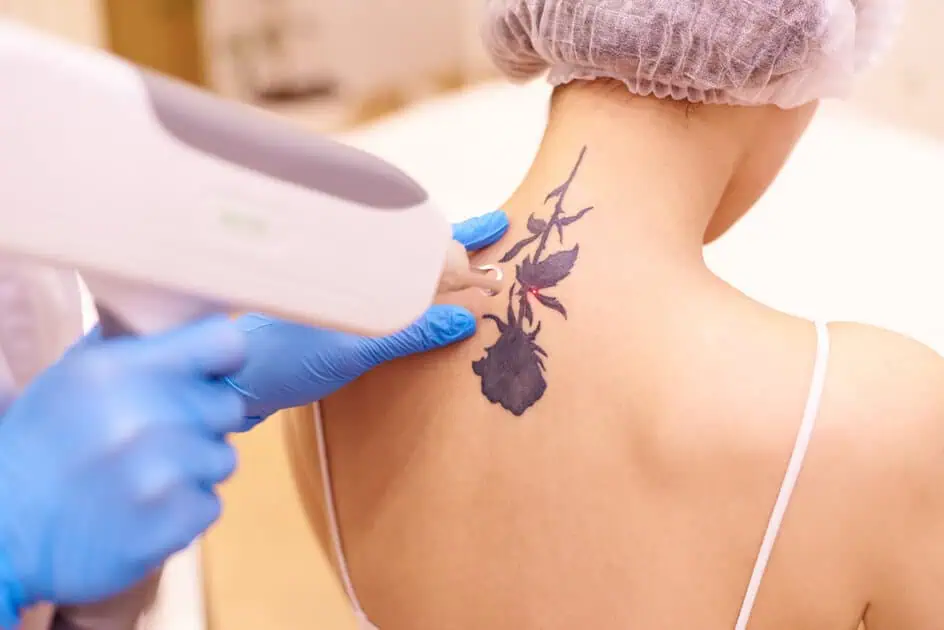 Tattoo Removal by Revenge MD in Las Vegas